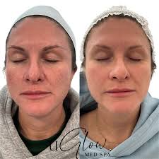 UGlow Med Spa