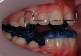 Smoothies made with fruits, vegetables, and protein supplements might be a good. The Use Of Functional Appliances In Contemporary Orthodontic Practice British Dental Journal