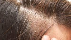 Pour as much as is needed onto your hair. Thin Hair Dry Skin Depression Tired Weight Issues Candice Robins