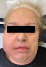 Image result for phlegmon on face)