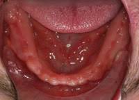 Gingivalis in 15 of 16 and 8 of 16 previously positive patients using. An Efficient Approach To Full Mouth Extractions Dentistry Today