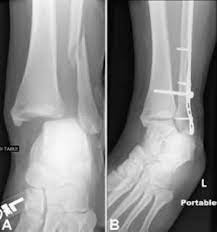 It takes about six weeks for broken ribs to heal on their own. Ankle Fractures Broken Ankle Orthoinfo Aaos