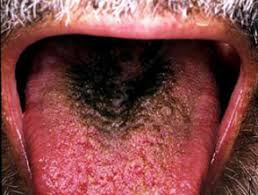 The appearance may be alarming, but it is a harmless condition. Hairy Tongue Dermnet Nz