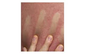 Both viruses are native to africa,. Gefahrliche Souvenirs Wie Erkenne Ich Dengue Chikungunya Und Co Klinik Via Medici