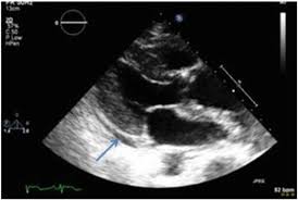 Image result for Pericarditis