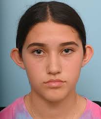 Otoplasty Before & After Photos