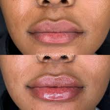 This patient came in wanting to balance out her lower lip to her upper lip,  as the upper was overpowering the lower. We added 0.5 cc of Kysse to her  lower lip