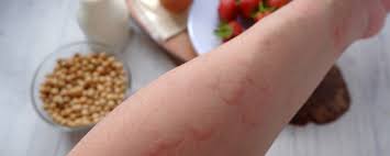 Image result for Papular urticaria