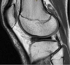 Hypermobile Lateral Meniscus Radsource