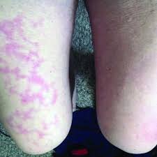 If you have fever, cough, shortness of breath, or any of the other symptoms listed above, please call your healthcare provider. Skin Manifestations Are Emerging In The Coronavirus Pandemic Mdedge Dermatology