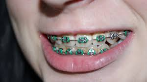 Brushing the same way as you did before braces will not keep your teeth as clean as it used to. How To Remove Plaque Buildup On Braces Oralcareexpert Com