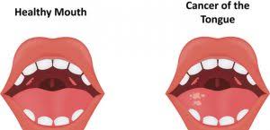 How often does oral cavity cancer spread to other parts of the body? The Signs And Symptoms Of Oral Cancer Best Dentist Staten Island