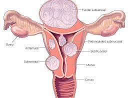 Looking to find the best treatment for uterine fibroids in miami, pompano, and south florida, we can help. Types Of Uterine Fibroids Best Treatment For Fibroids In Trivandrum