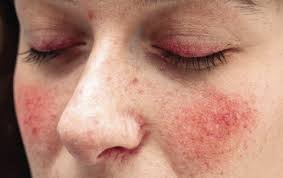 Rosacea Resource Center The Dermatologist