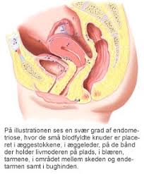 Lændesmerter defineres som smerter eller ubehag i ryggen mellem de nederste ribben og det nederste af balderne. Endometriose Skansom Operation Aleris Hamlet