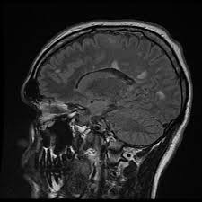 However, conventional mri measures, such as the use of lesion volume and. Esclerosis Multiple Msblog Utilidad De La Mri En El Diagnostico Diferencial En Esclerosis Multiple