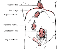 Code Fat Alberts Hernia Repair In 5 Easy Steps Aapc