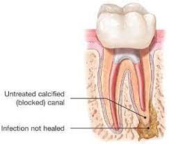 Endodontic Retreatment Explained American Association Of Endodontists