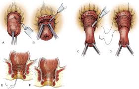 Image result for Rectal prolapse