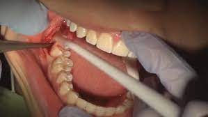 Pin On Best Invisalign Pediatric Dentist