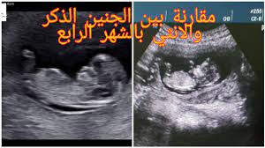مقارنة بالسونار بين الجنين الذكر والانثي بالشهر الرابع youtube
