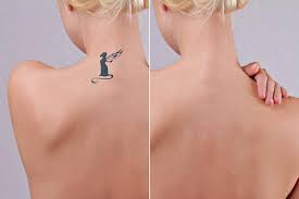 This is just an average, and you may see results in fewer treatments. What Is The Best Laser Treatment For Tattoo Removal
