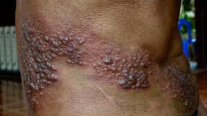 Image result for Varicella zoster on human skin