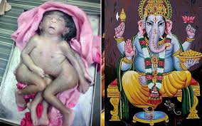 Maybe you would like to learn more about one of these? Eight Limbed Indian Baby Worshipped As Hindu God