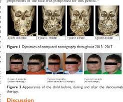 Medical definition of cherubism : Cherubism In 8 Years Old Child Treatment Experience Semantic Scholar