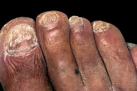 Nail fungus types toenail and foot fungus different types of toenail fungus athlete's foot effects on sole prescription. Fungal Nail Infection Nhs