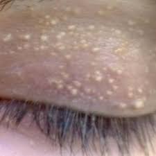 A chalazion happens when a tiny part of your. She S Got Strange White Bumps On Her Eyelids But Had No Idea It S A Sign Of This Trattamenti Naturali Rimedi Per La Salute Rimedi
