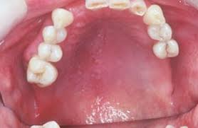 Image result for Oral herpes roof of mouth