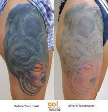 In general, it takes about six to eight sessions to completely remove a tattoo, so you're looking at a minimum of $1,200 to have your tattoos entirely erased from your body. Go Tattoo Removal Huge Piece With Huge Progress After 5 Treatments