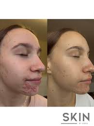 Look at This transformation…Thanks for sharing Kimberly Majestic Stoker 🌸  “My skin still isn't perfect, but with years of consistency and what I like  to call big girl skincare my skin is