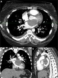 No need to file a lawsuit. Malignant Pericardial Mesothelioma Treated Using Volumetric Modulated Arc Therapy With A Simultaneous Integrated Boost Advances In Radiation Oncology