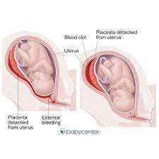 What Is Partial Placental Abruption And Complete Placental Abruption Babycenter