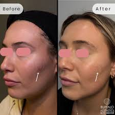 Smoothing Away Forehead Lines, 11s, and Crow's Feet with 'Tox