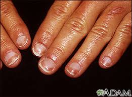 Nail Abnormalities Information Mount Sinai New York