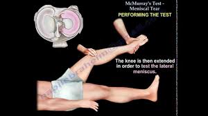 Image result for Ballottable Patella Sign