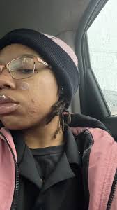 How to treat frequent breakouts and dark mark scarring