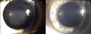 Management Of Corneal Haze After Photorefractive Keratectomy |  Ophthalmology And Therapy