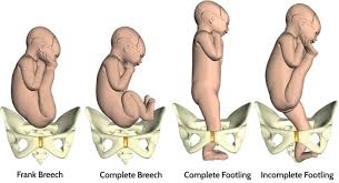 Image result for Breech Delivery