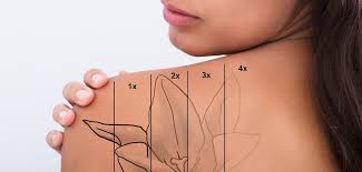 Before, during, after so many people across northeast wisconsin and america alike do not even know that tattoo removal exists! Laser Tattoo Removal Learn About Cost Risks Results