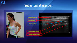 Image result for Subacromial Space Injection