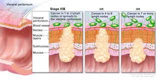 Rectal Cancer Treatment Pdq Patient Version National Cancer Institute Read about rectal cancer (cancer of the rectum), which affects the lower part of the colon that connects to the anus.