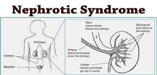 Kencing berbuih ni mungkin berpunca daripada beberapa sebab yang tak bahaya seperti : Menurut Doktor Ini Simpton Penyakit Yang Anda Hidapi Bila Kaki Bengkak Kencing Berbuih