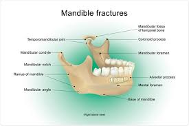 Os de la mâchoire inférieure sur le bord duquel s'implantent les la mandibule (mâchoire inférieure) est le seul os mobile du crâne. Quelles Sont Des Fractures De La Mandibule