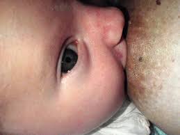 Que Ocurre Si Mi Hijo Tiene El Frenillo De La Lengua Demasiado Corto