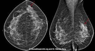 However, it may be necessary to take more images of each breast, and. Mammography 3d Mammography Tomosynthesis Densebreast Info Inc