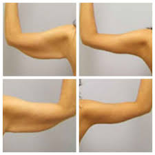 3 Weeks Post Arm Liposuction 7 Liposuction Before And After Arm Lift Surgery Arm Liposuction Liposuction